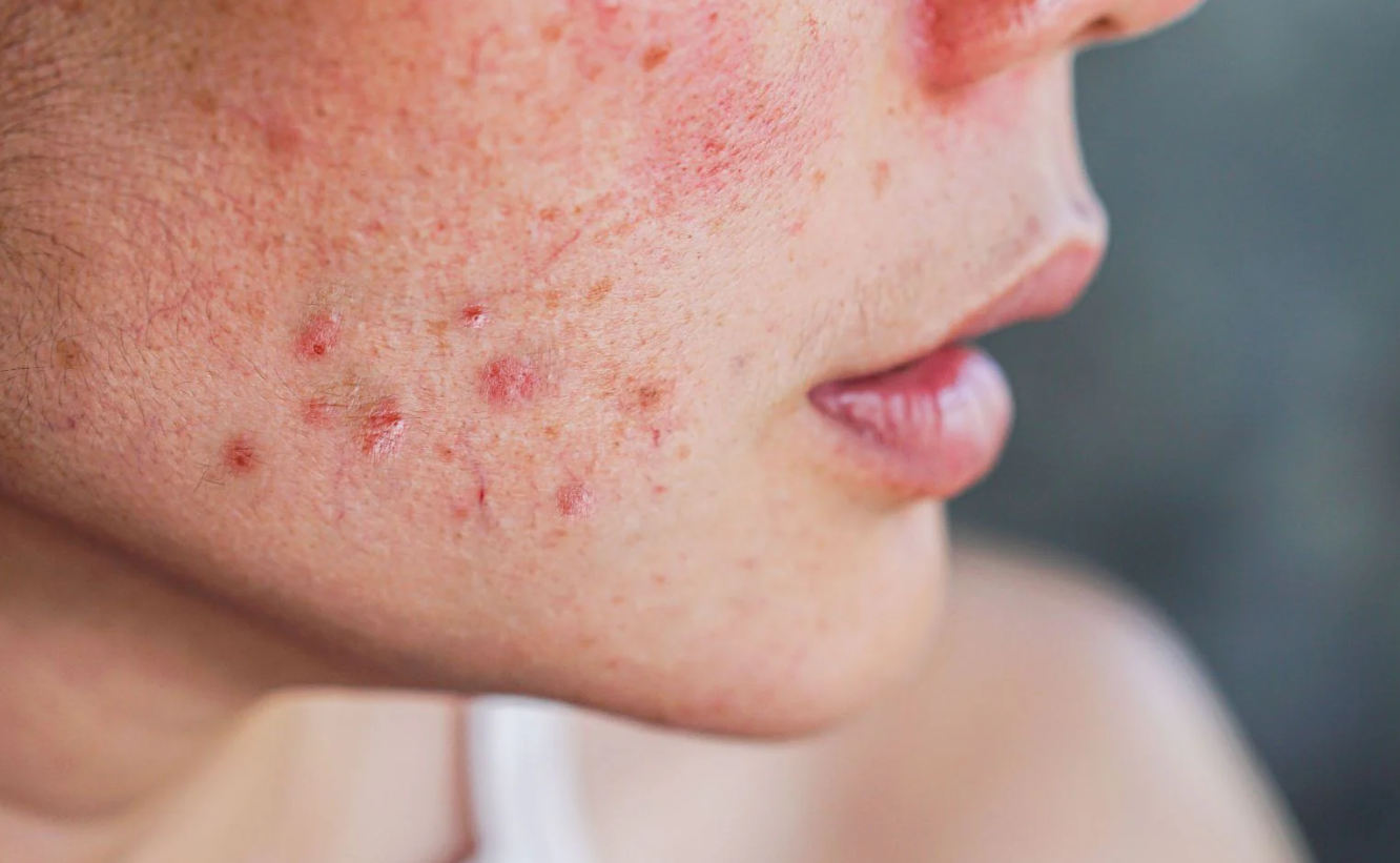 Why Popping Pimples Can Worsen Your Skin Condition 2